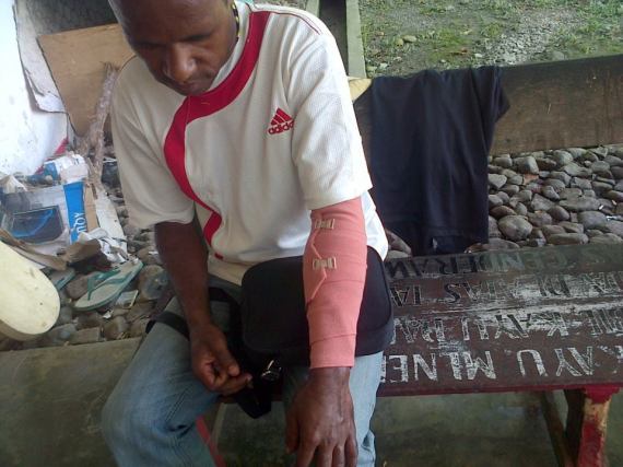 Photo: Markus Giban (19), one of the members of the KNPB who was arrested by police and had his arm broken. (Photo: KNPB / SuaraPapua.com)